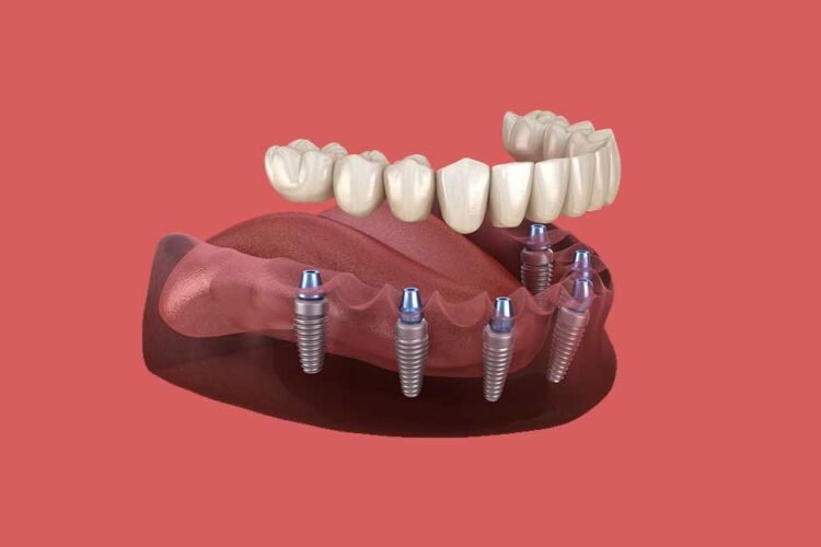 Missing Teeth - treatment