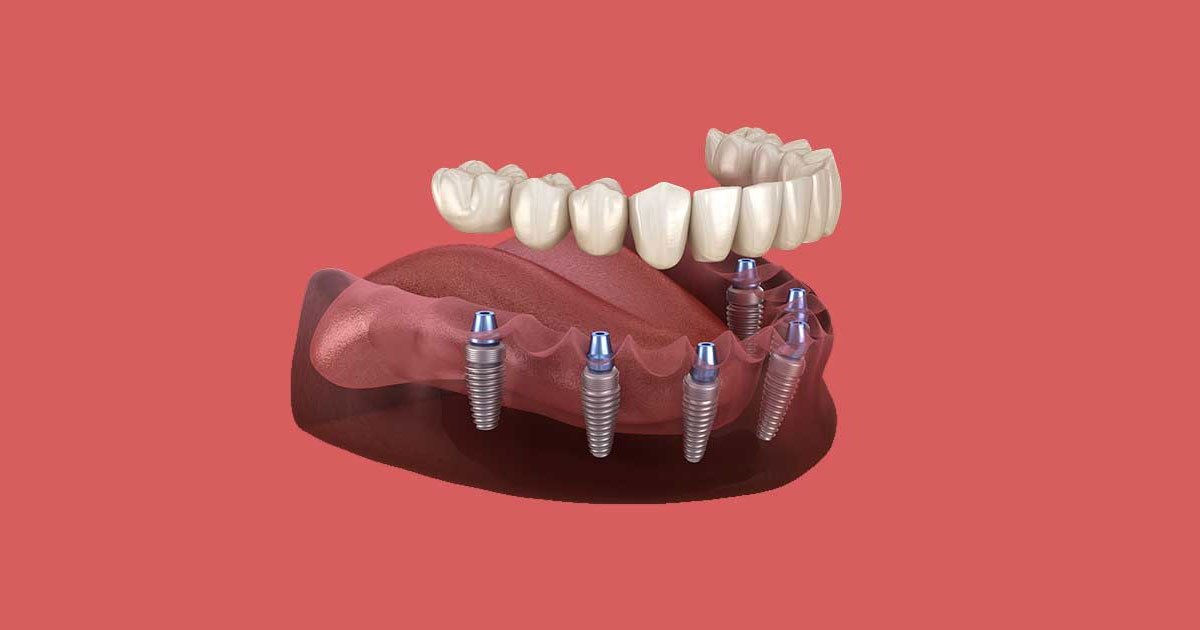 Missing Teeth - treatment