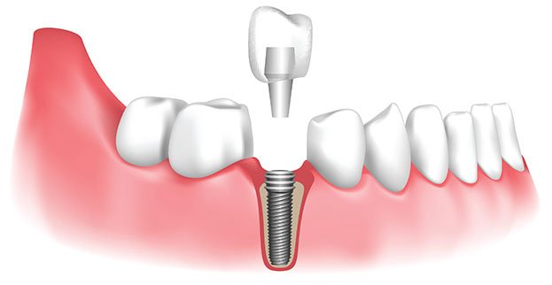Dental Implants – Solution for Missing Teeth 2 How dental implants are placed