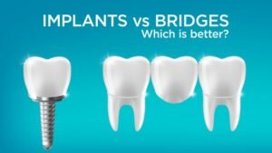 Implants vs bridges .. what is best for you? 2 Implants vs bridges .. what is best for you?