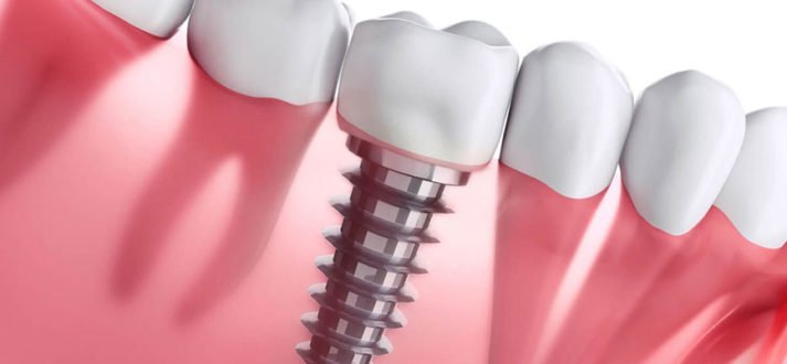 Dental Implants