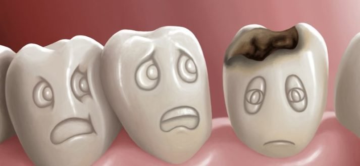tooth decay