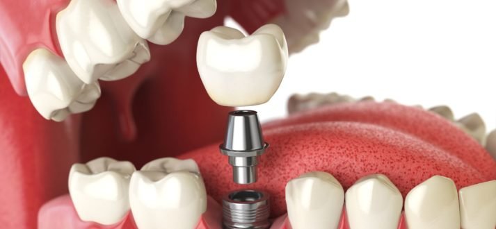 Modern Dental Implants