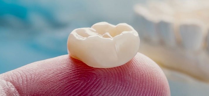 Metal-free dental crowns for broken front teeth make you look younger! 1 32