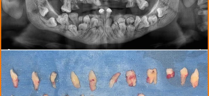 36 impacted teeth 713x330 1