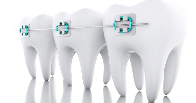 Dental Braces