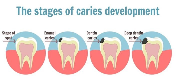 The best treatment for dental caries and cavities at Partha Dental 1 dental caries