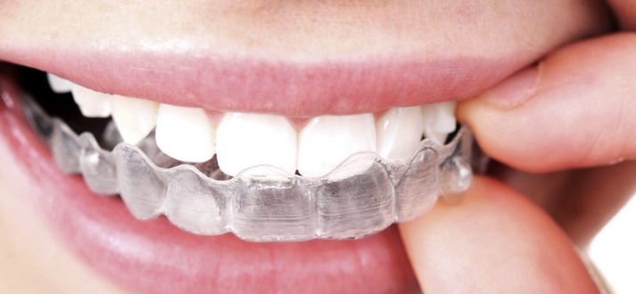 Aligners for the young and old
