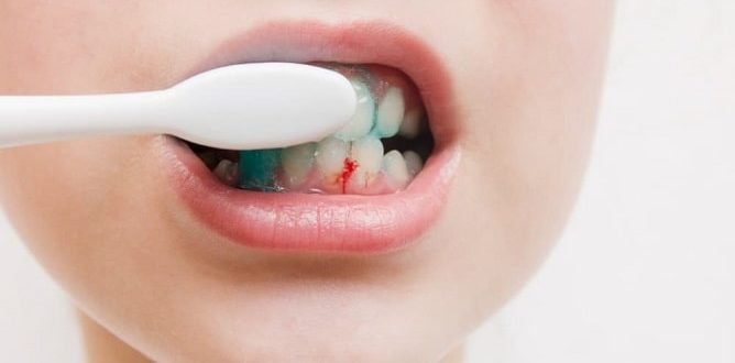 Bleeding gums – should I be worried? 1 Bleeding gums