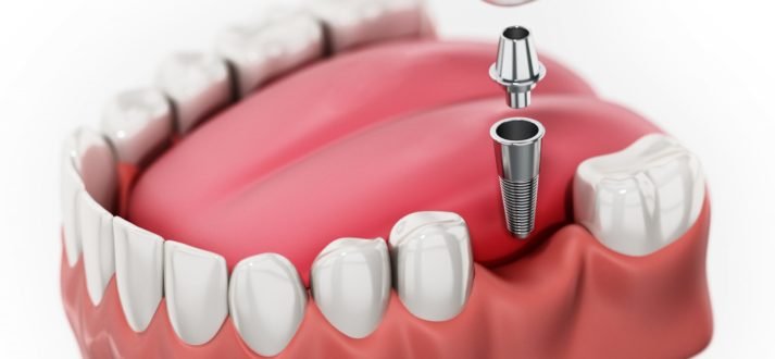 Instant dental implants for tooth loss! 1 instant dental implant
