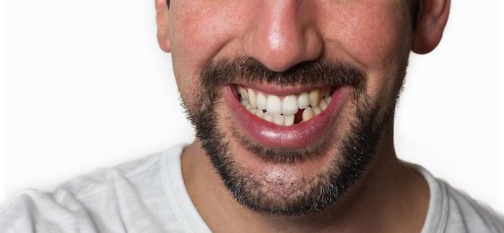 5 Important Reasons to Replace Your Missing Tooth in Partha 1 Why should you replace missing teeth