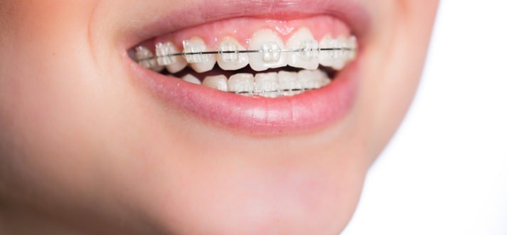 Braces for kids