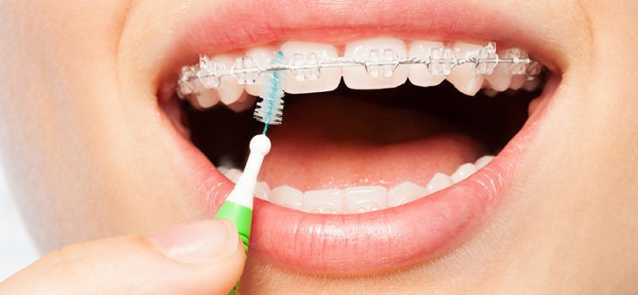 Braces Cleaning Tips