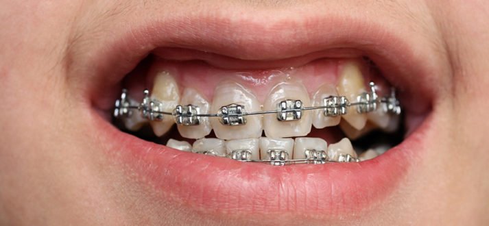 Children Who Want Braces