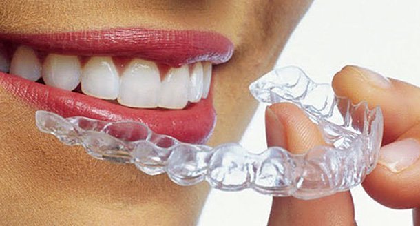 Aligners