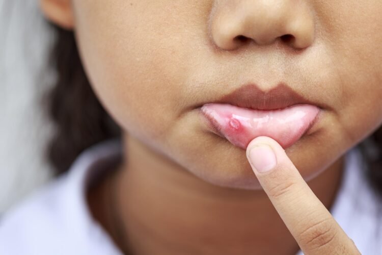 Clear Up A Canker Sore