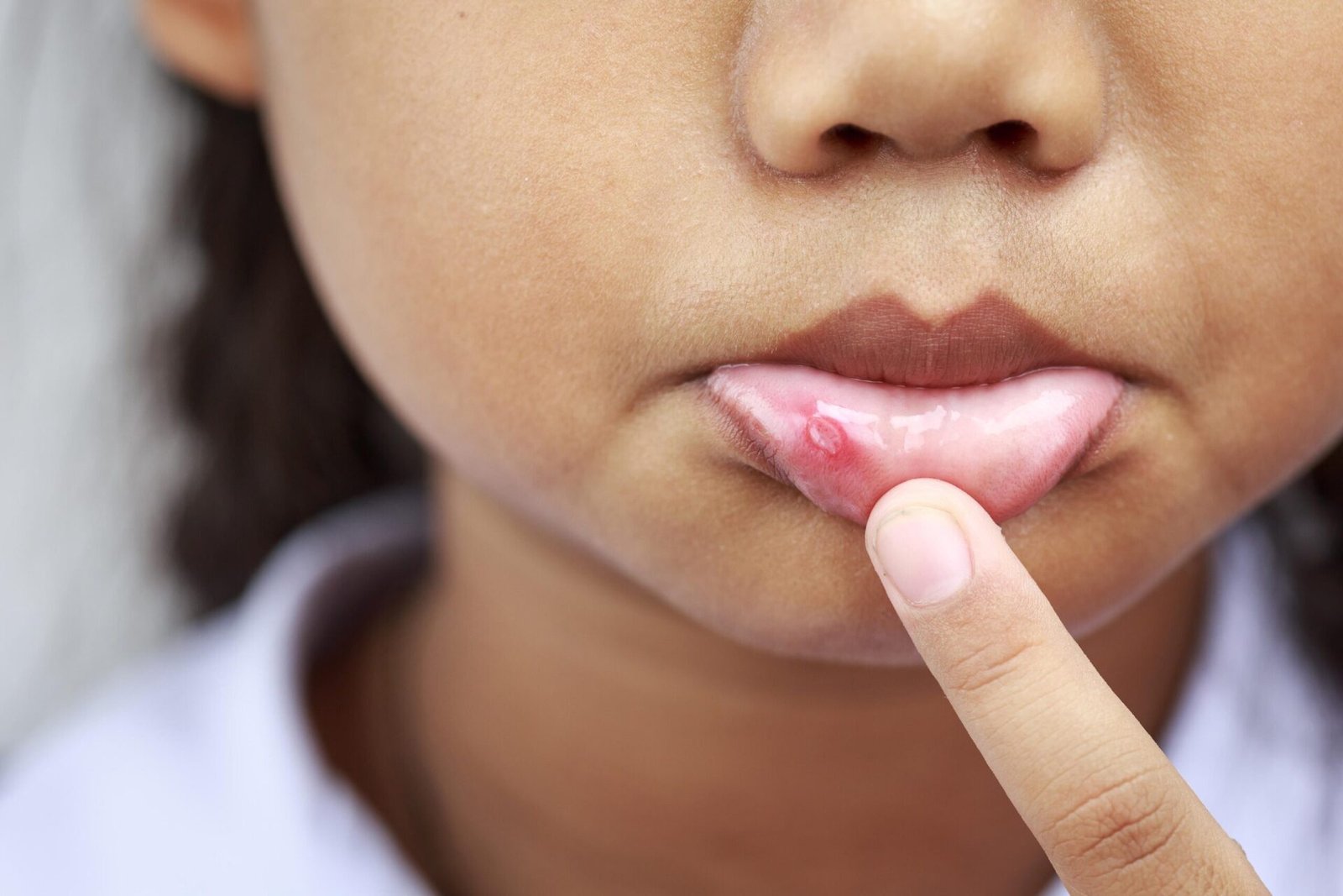 Clear Up A Canker Sore