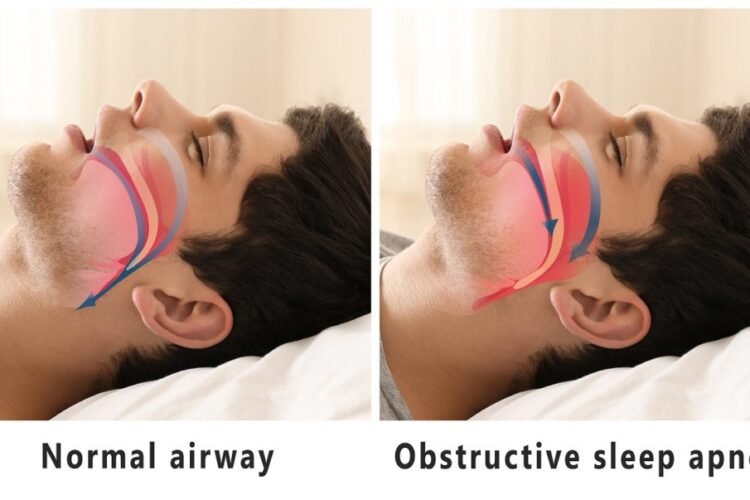 sleep apnea