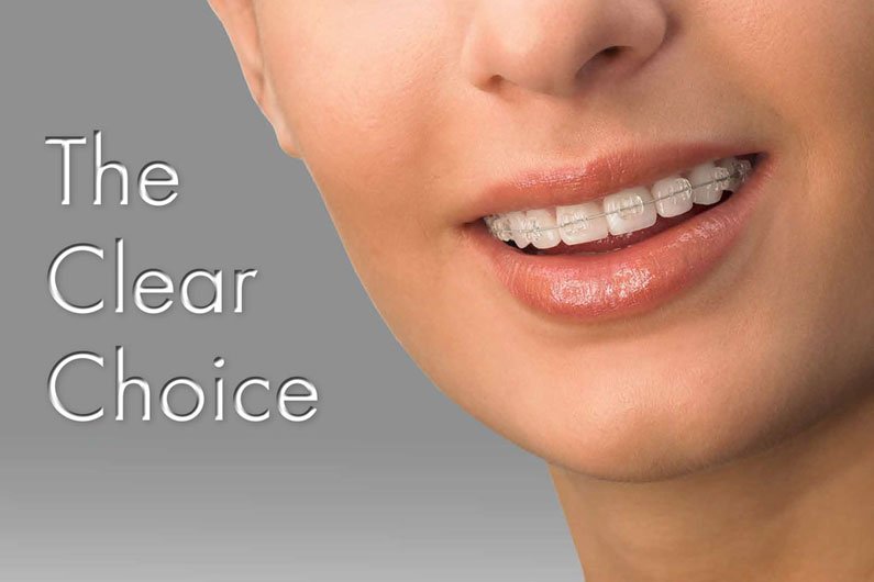 Ceramic Braces treatment