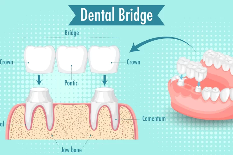 Implant Vs Bridge ... What Is Best For You? 1 Dental Bridge And Crown