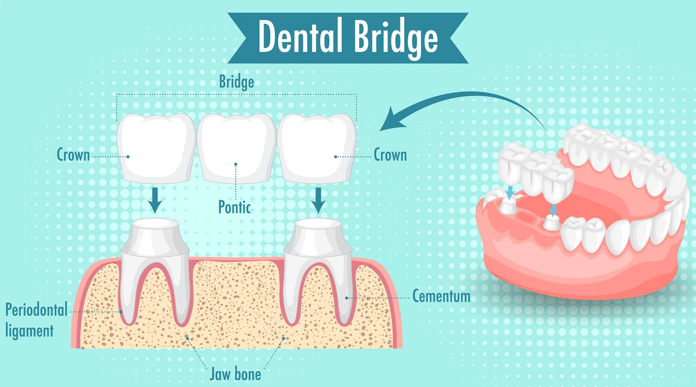 Dental Bridge And Crown