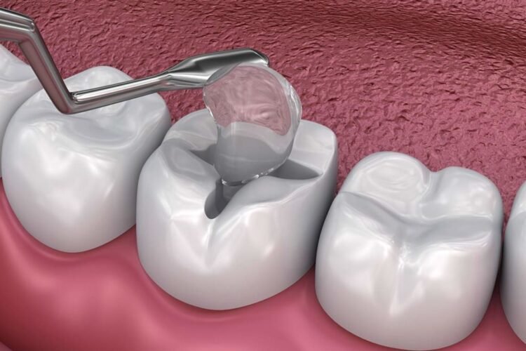 Dental fillings
