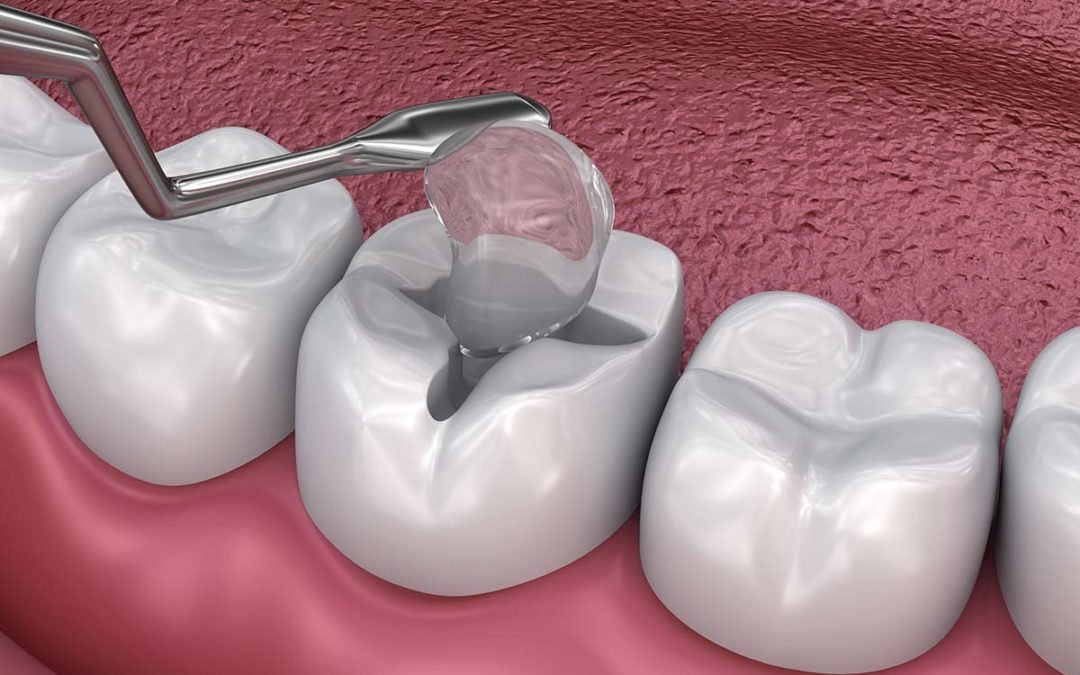 Dental fillings