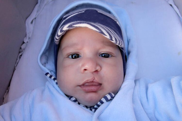 CLEFT LIP AND CLEFT PALATE