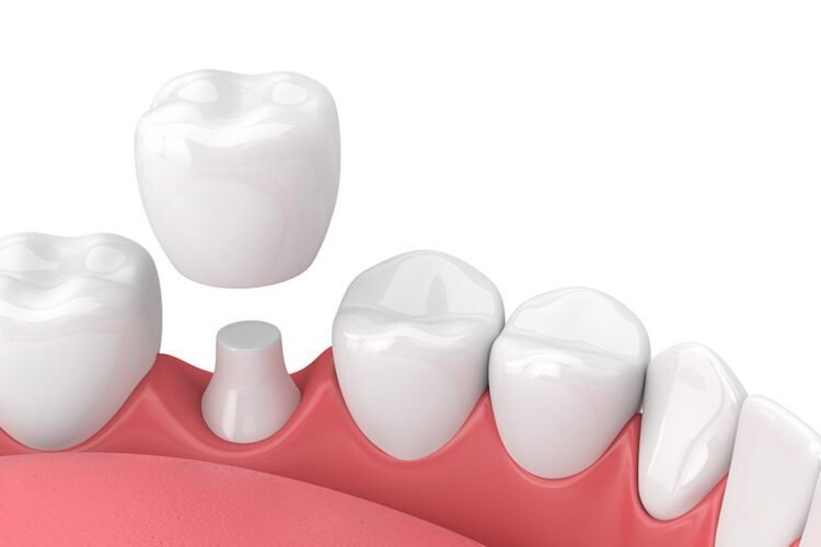 tooth crown treatment