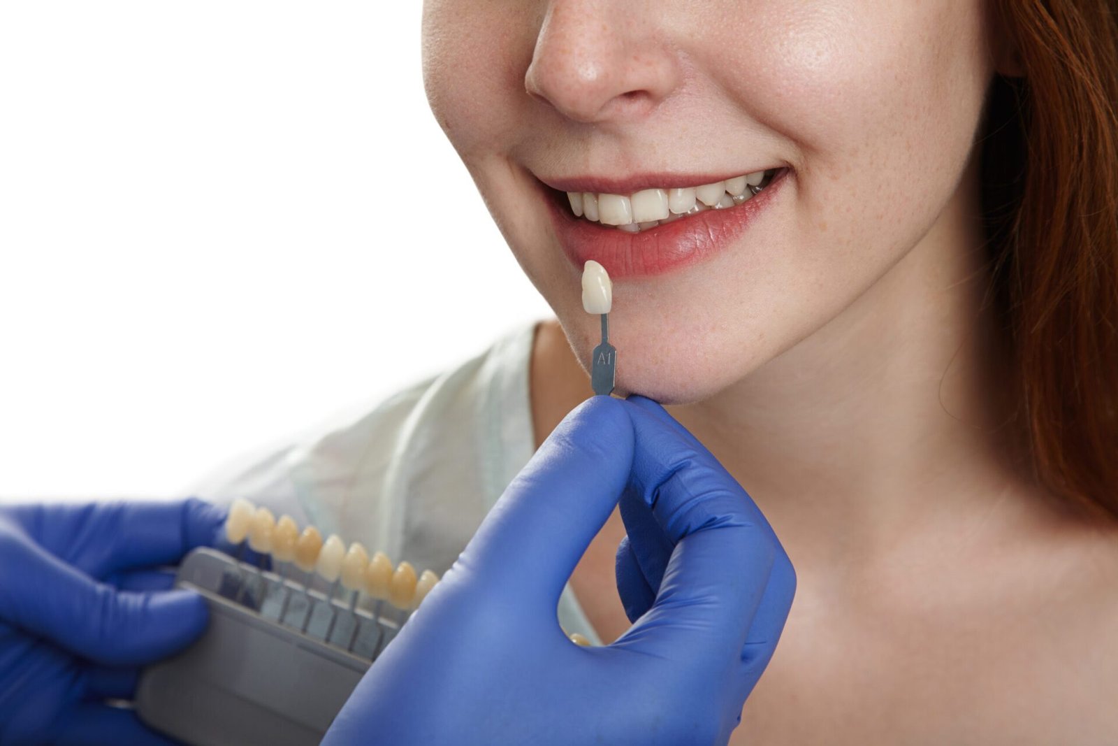 Dental veneers