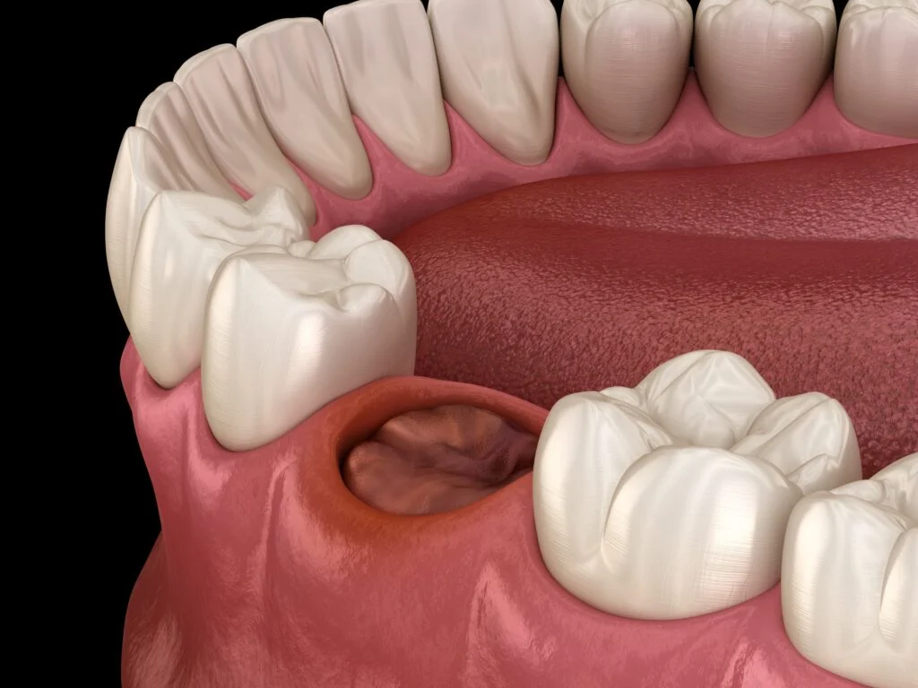 Dry Socket after Tooth Extraction