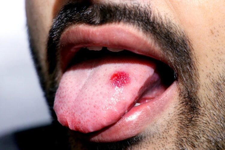 Mouth cancer treatment