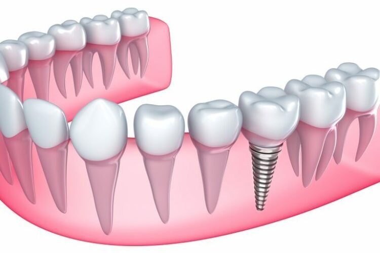 teeth implants treatment
