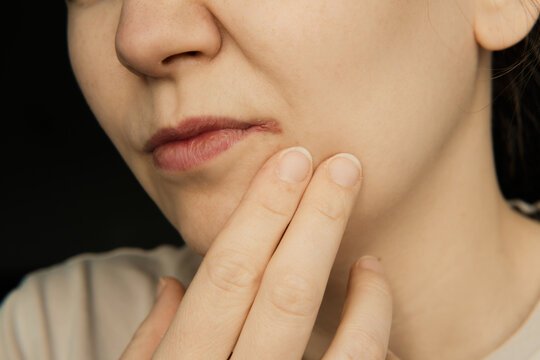 Angular Cheilitis treatment