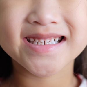 Chipped Teeth Are Common In Both Adults And Children 2 chipped teeth