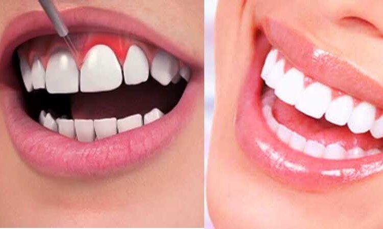Gum contouring: What is it and who needs it? 1 gum contouring treatment