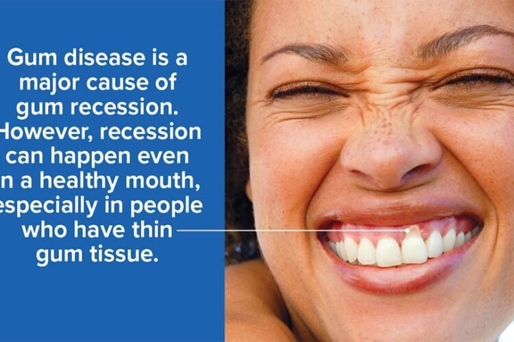 GUM RECESSION – CAUSES AND SYMPTOMS 1 gum recession treatment