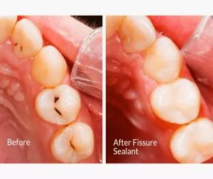 Everything You Need To Know About Pit And Fissure Sealants 2 pitandfissure
