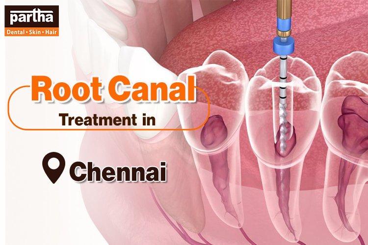 Root Cana Treatment Chennai
