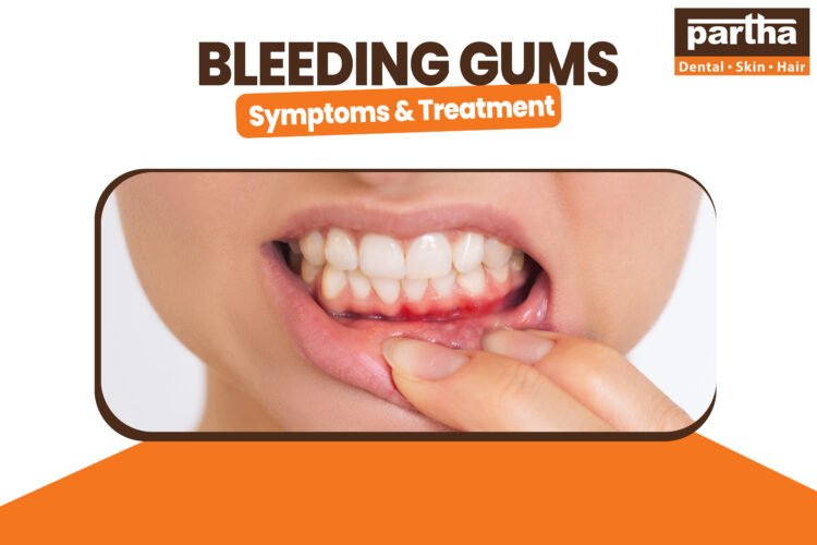 Bleeding Gums – Symptoms, Causes, Treatment and Home Remedies 1 Bleeding Gums 1