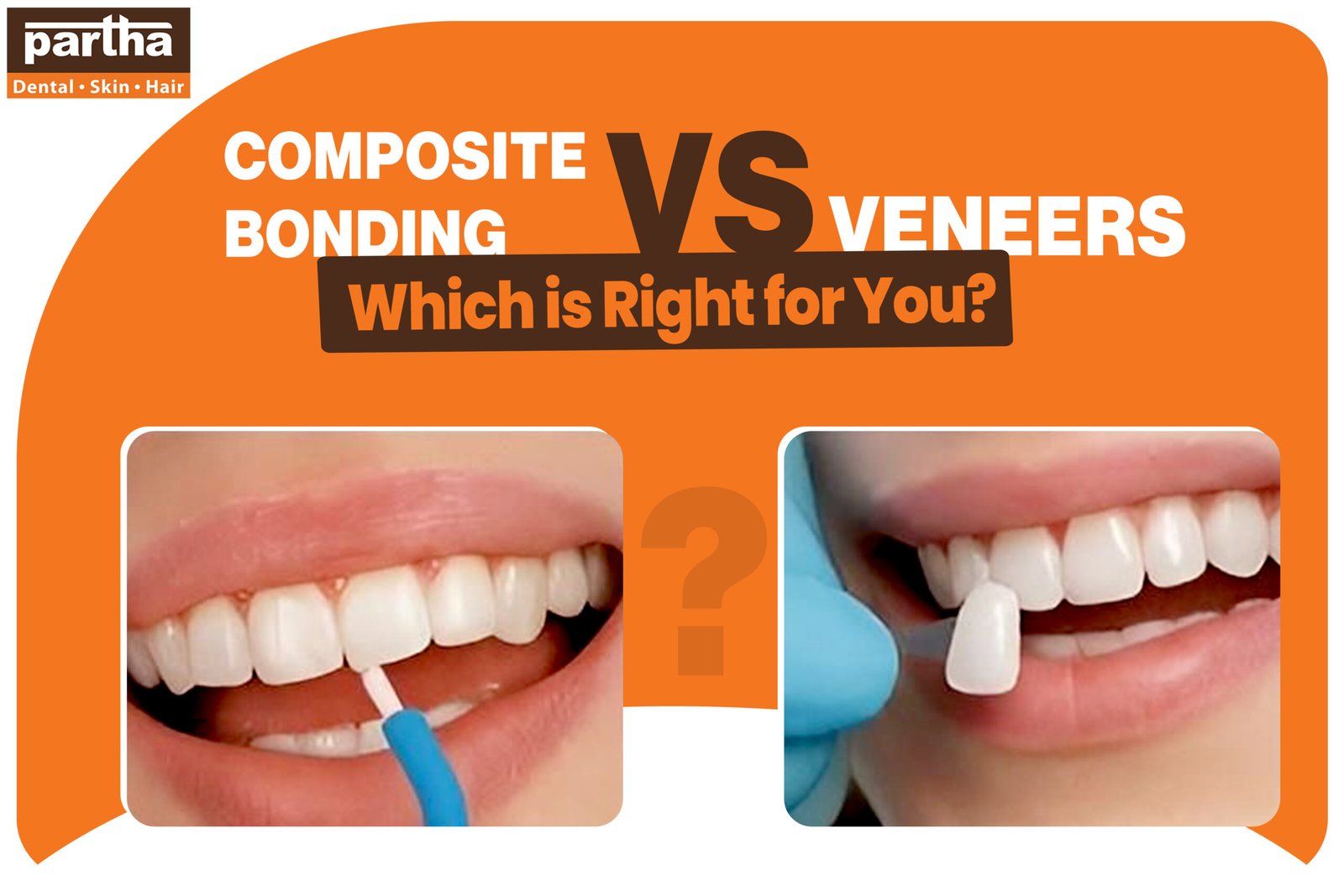 Composite Bonding vs Veneers 1 scaled