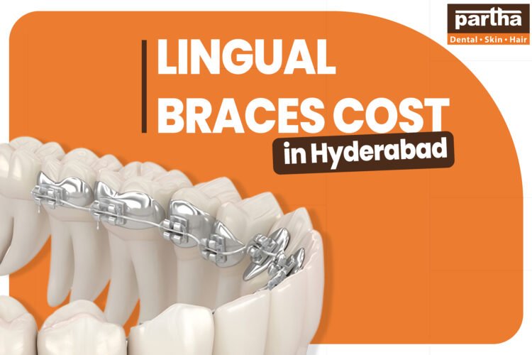 Lingual Braces Cost