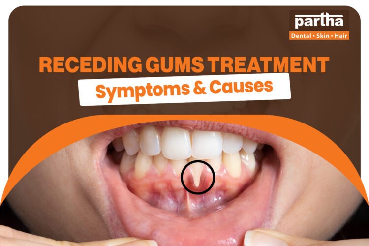 Receding Gums Treatment 1