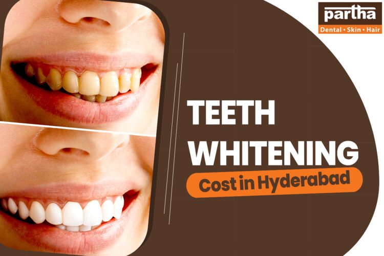 Teeth whitening cost in hyd